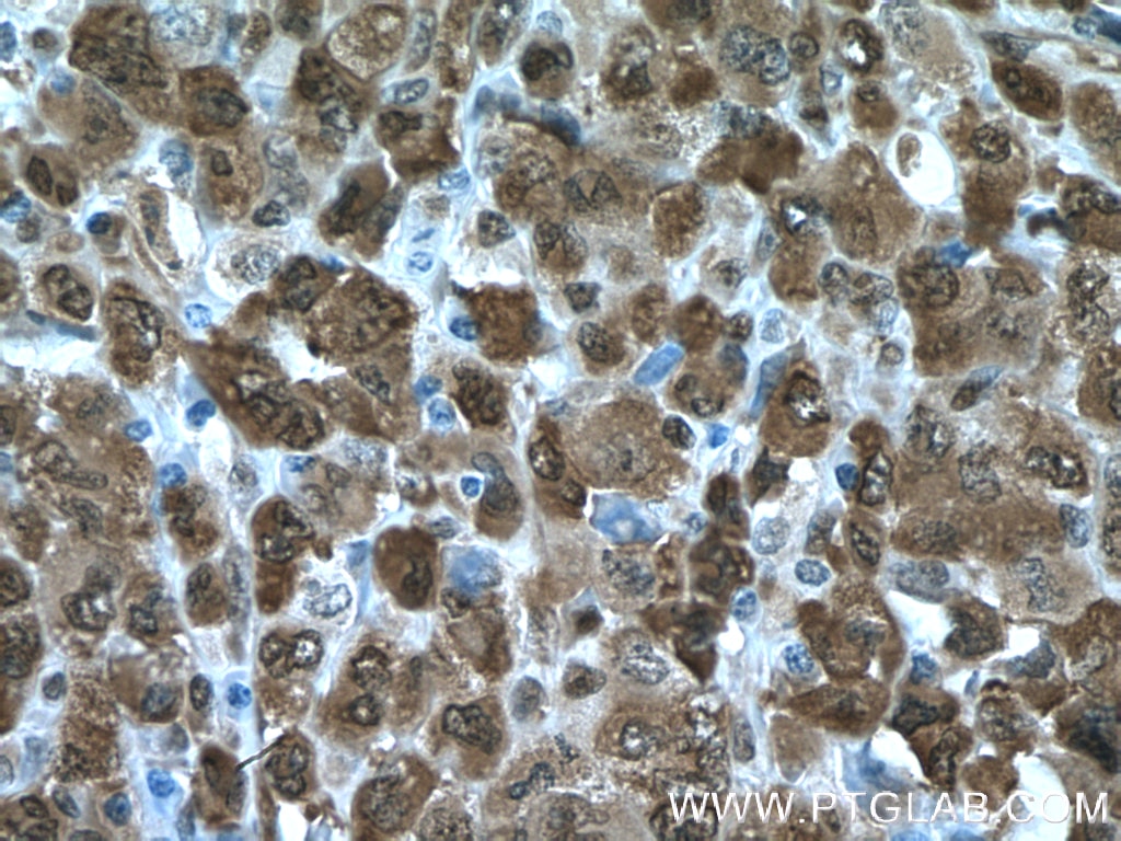 Immunohistochemistry (IHC) staining of human lymphoma tissue using NAMPT/PBEF Polyclonal antibody (11776-1-AP)