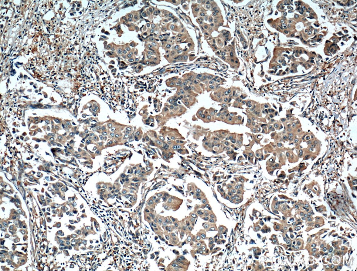 Immunohistochemistry (IHC) staining of human breast cancer tissue using NAMPT/PBEF Monoclonal antibody (66385-1-Ig)
