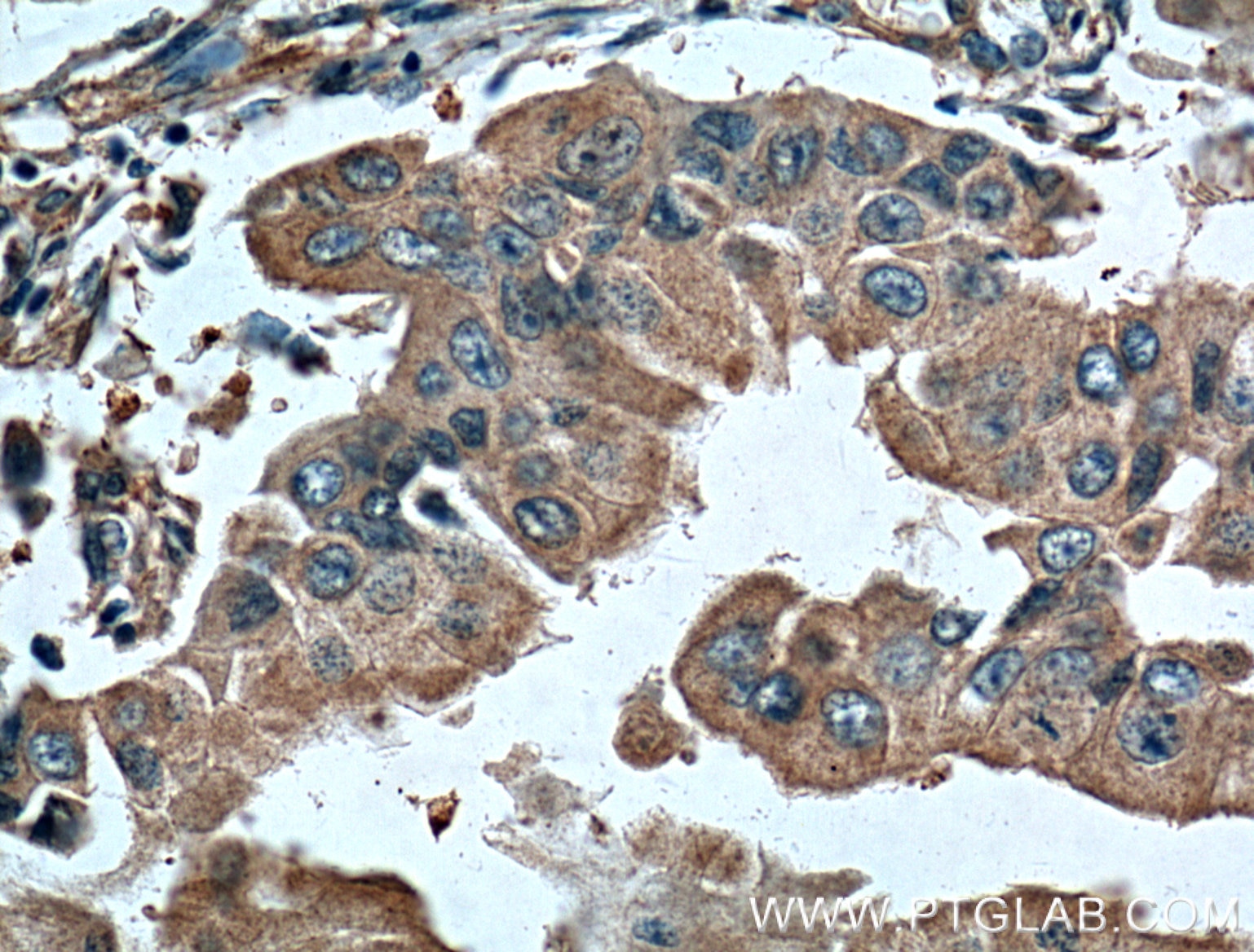 Immunohistochemistry (IHC) staining of human breast cancer tissue using NAMPT/PBEF Monoclonal antibody (66385-1-Ig)