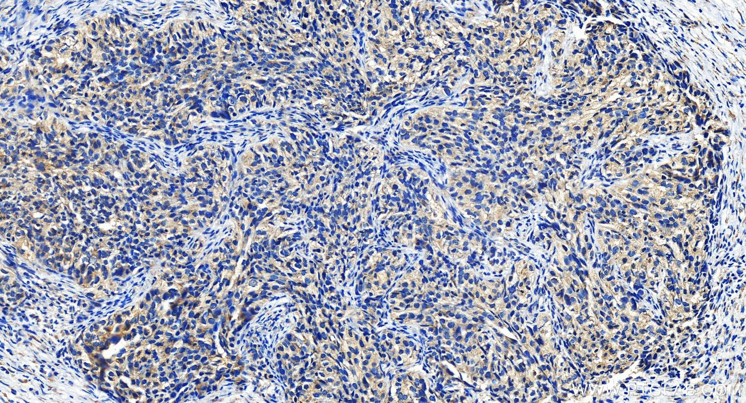 Immunohistochemistry (IHC) staining of human ovary cancer tissue using NANP Polyclonal antibody (12519-1-AP)