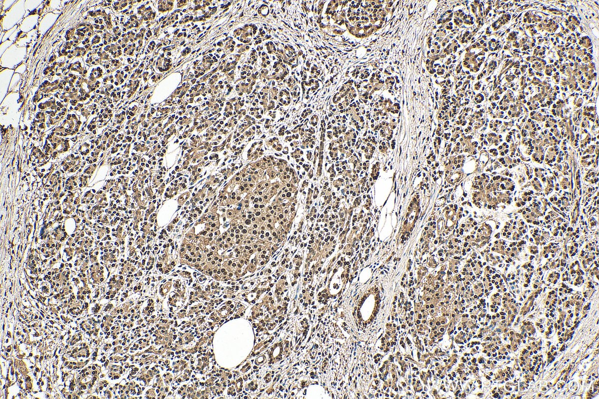 Immunohistochemistry (IHC) staining of human pancreas cancer tissue using NANS Polyclonal antibody (15163-1-AP)