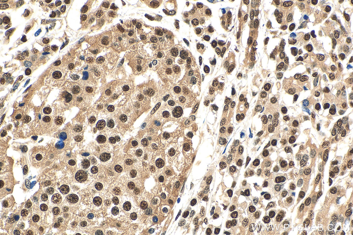 Immunohistochemistry (IHC) staining of human pancreas cancer tissue using NANS Polyclonal antibody (15163-1-AP)