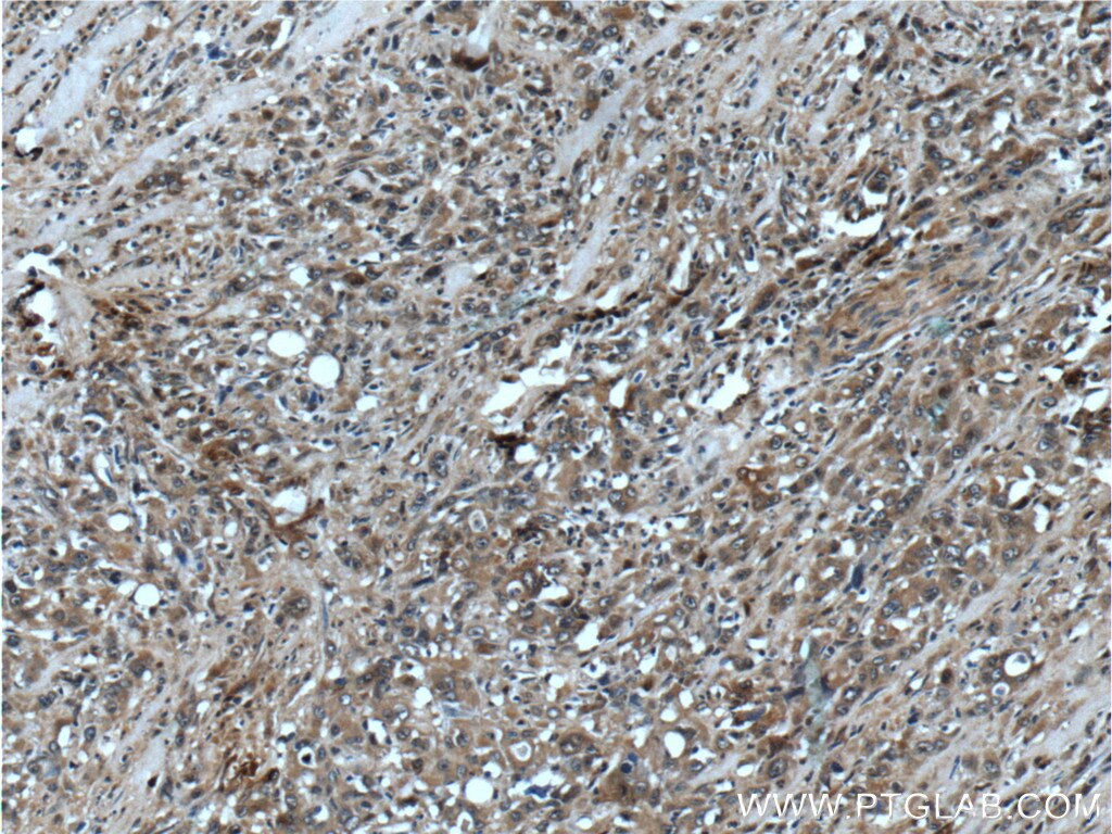 Immunohistochemistry (IHC) staining of human stomach cancer tissue using NANS Polyclonal antibody (15163-1-AP)