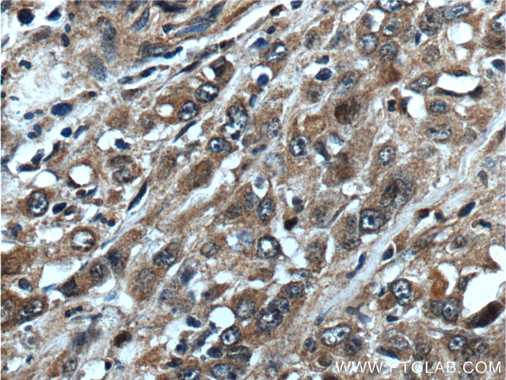 Immunohistochemistry (IHC) staining of human stomach cancer tissue using NANS Polyclonal antibody (15163-1-AP)