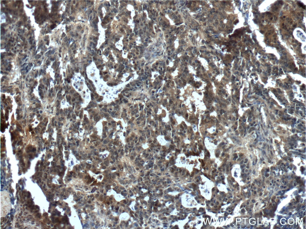 Immunohistochemistry (IHC) staining of human ovary tumor tissue using NANS Polyclonal antibody (15163-1-AP)