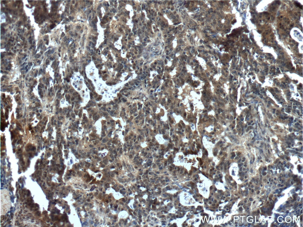 Immunohistochemistry (IHC) staining of human ovary tumor tissue using NANS Polyclonal antibody (15163-1-AP)