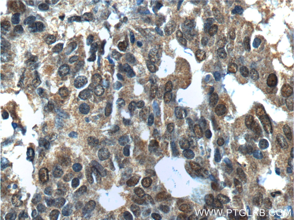 Immunohistochemistry (IHC) staining of human ovary tumor tissue using NANS Polyclonal antibody (15163-1-AP)