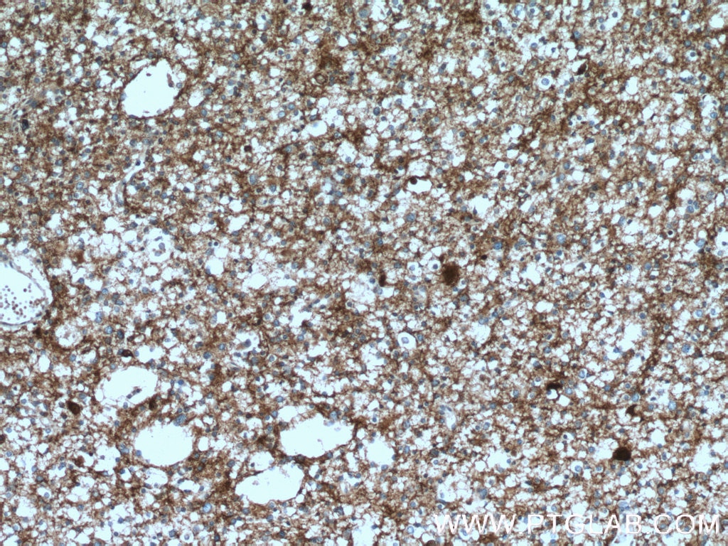 IHC staining of human gliomas using 14106-1-AP