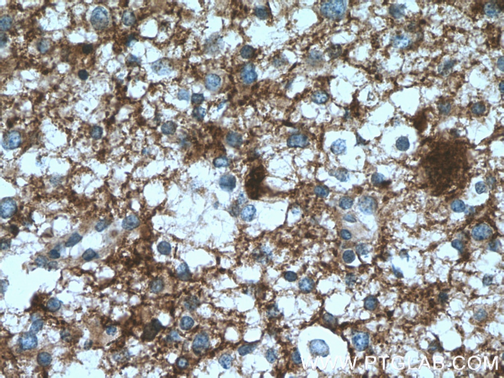 IHC staining of human gliomas using 14106-1-AP