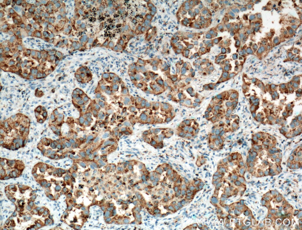 Immunohistochemistry (IHC) staining of human lung cancer tissue using Napsin A Polyclonal antibody (16558-1-AP)