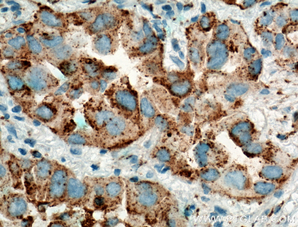 Immunohistochemistry (IHC) staining of human lung cancer tissue using Napsin A Polyclonal antibody (16558-1-AP)