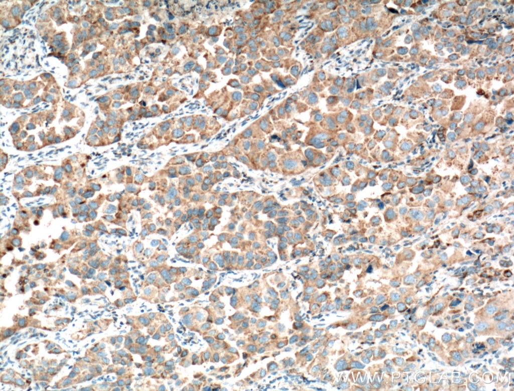 Immunohistochemistry (IHC) staining of human lung cancer tissue using Napsin A Polyclonal antibody (16558-1-AP)