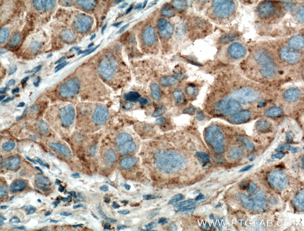 Immunohistochemistry (IHC) staining of human lung cancer tissue using Napsin A Polyclonal antibody (16558-1-AP)