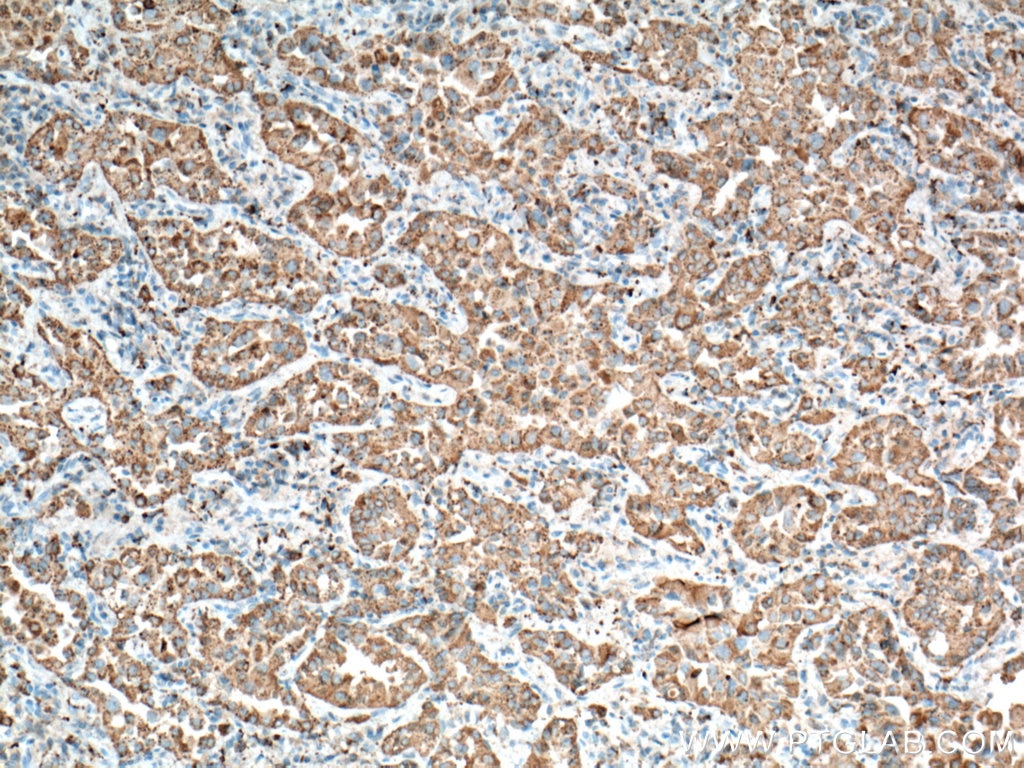 Immunohistochemistry (IHC) staining of human lung cancer tissue using Napsin A Monoclonal antibody (60259-2-Ig)