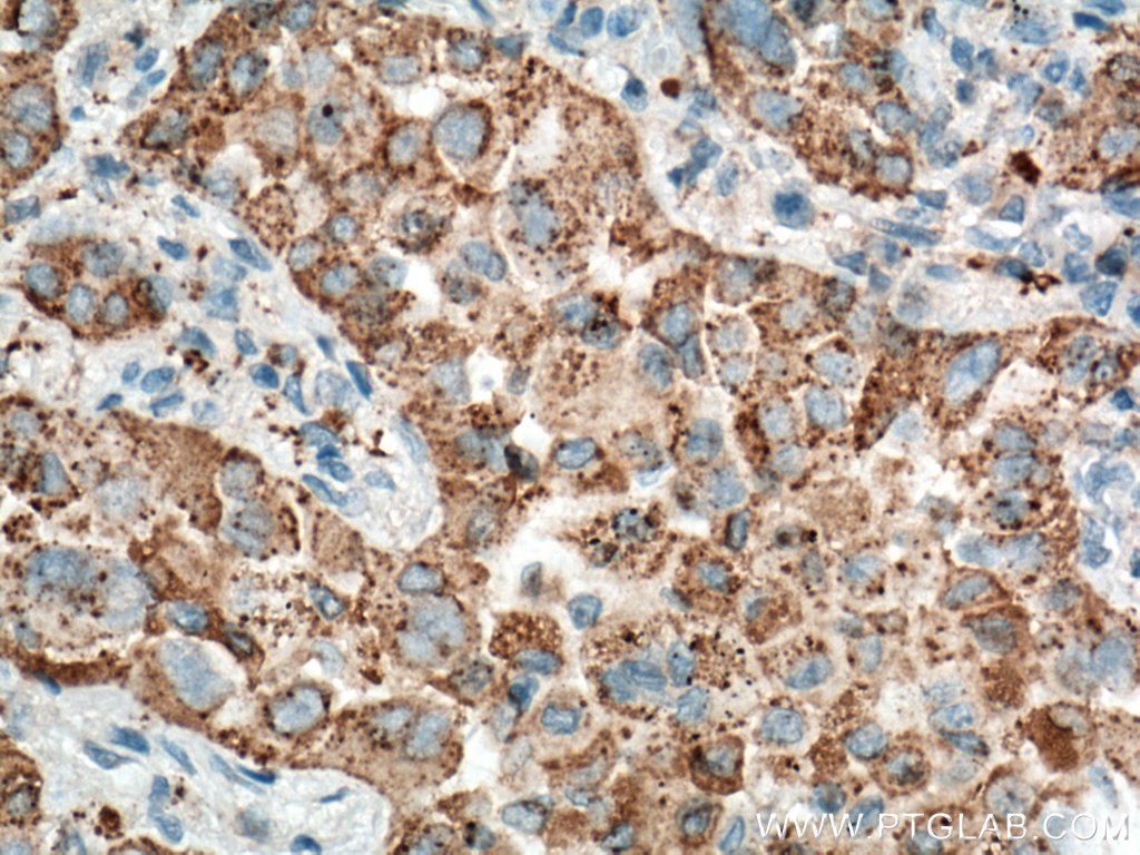 Immunohistochemistry (IHC) staining of human lung cancer tissue using Napsin A Monoclonal antibody (60259-2-Ig)