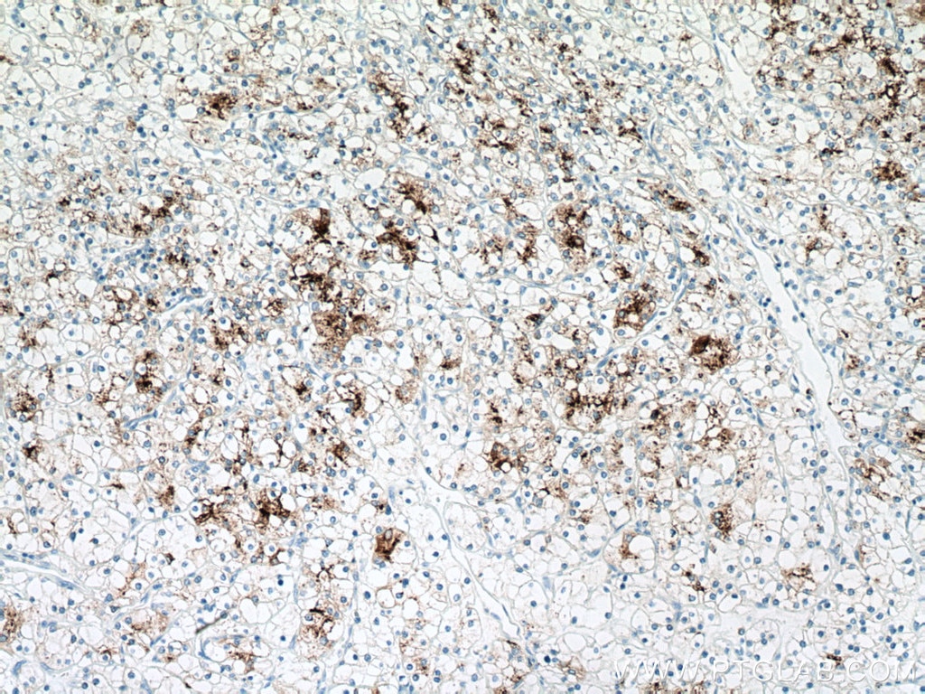 Immunohistochemistry (IHC) staining of human renal cell carcinoma tissue using Napsin A Monoclonal antibody (60259-2-Ig)