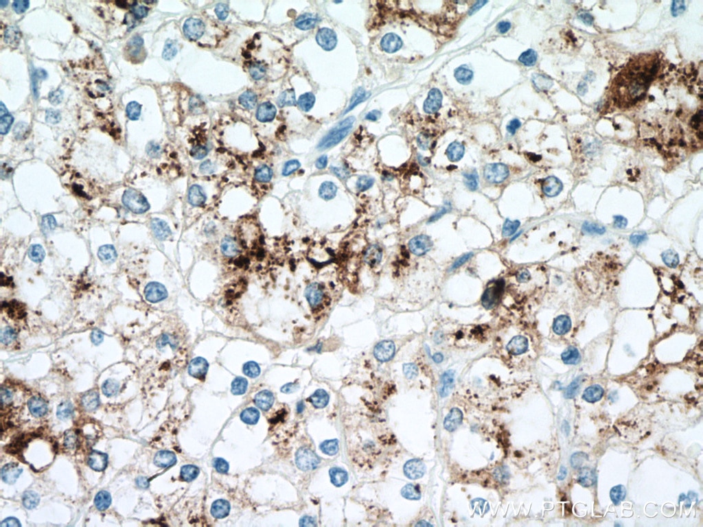 Immunohistochemistry (IHC) staining of human renal cell carcinoma tissue using Napsin A Monoclonal antibody (60259-2-Ig)