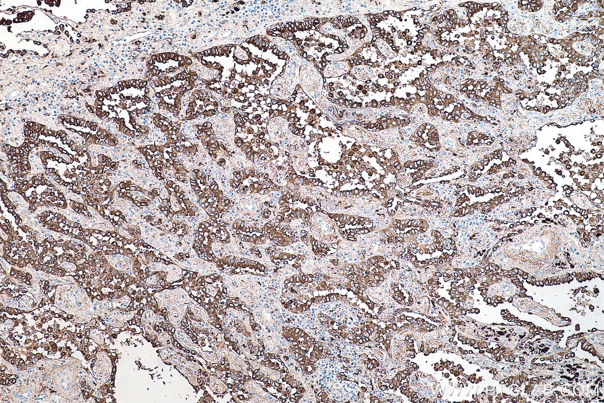 IHC staining of human lung cancer using 60259-2-Ig Immunohistochemistry (IHC) staining of human lung cancer tissue using Napsin A Monoclonal antibody (60259-2-Ig)