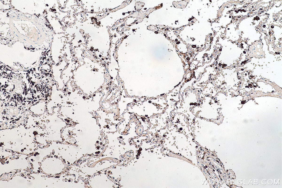 IHC staining of human lung cancer using 60259-2-Ig Immunohistochemistry (IHC) staining of human lung cancer tissue using Napsin A Monoclonal antibody (60259-2-Ig)