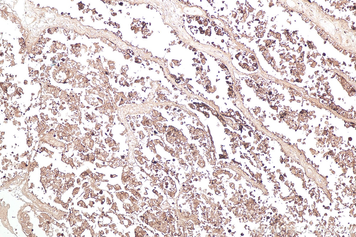 IHC staining of human ovary tumor using 60259-2-Ig Immunohistochemistry (IHC) staining of human ovary tumor tissue using Napsin A Monoclonal antibody (60259-2-Ig)