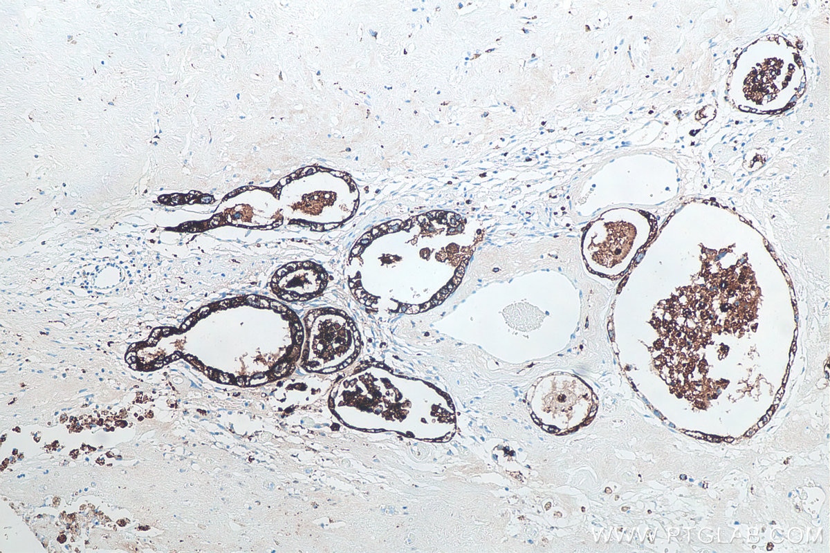 IHC staining of human ovary tumor using 60259-2-Ig Immunohistochemistry (IHC) staining of human ovary tumor tissue using Napsin A Monoclonal antibody (60259-2-Ig)