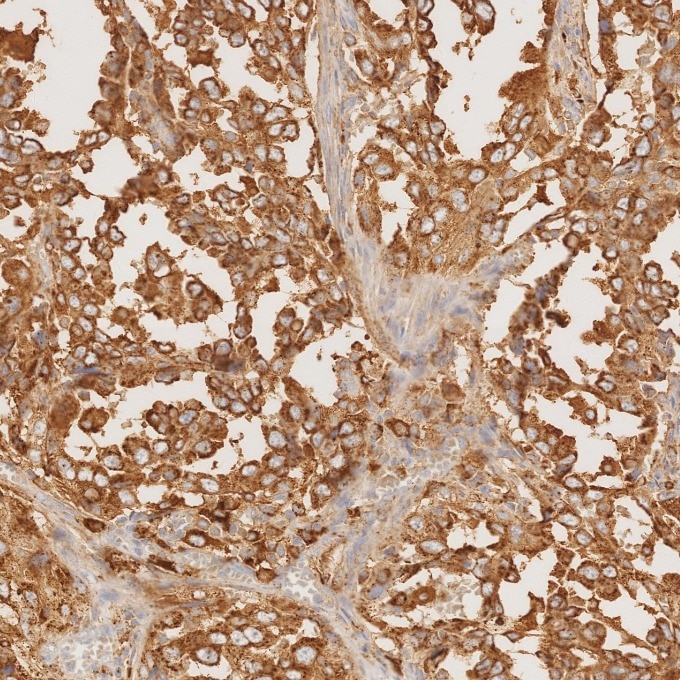 IHC staining of human lung cancer using 60259-2-Ig Immunohistochemistry (IHC) staining of human lung cancer tissue using Napsin A Monoclonal antibody (60259-2-Ig)