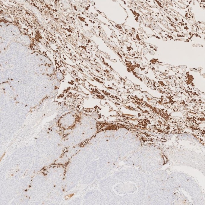 IHC staining of human lung cancer using 60259-2-Ig Immunohistochemistry (IHC) staining of human lung cancer tissue using Napsin A Monoclonal antibody (60259-2-Ig)