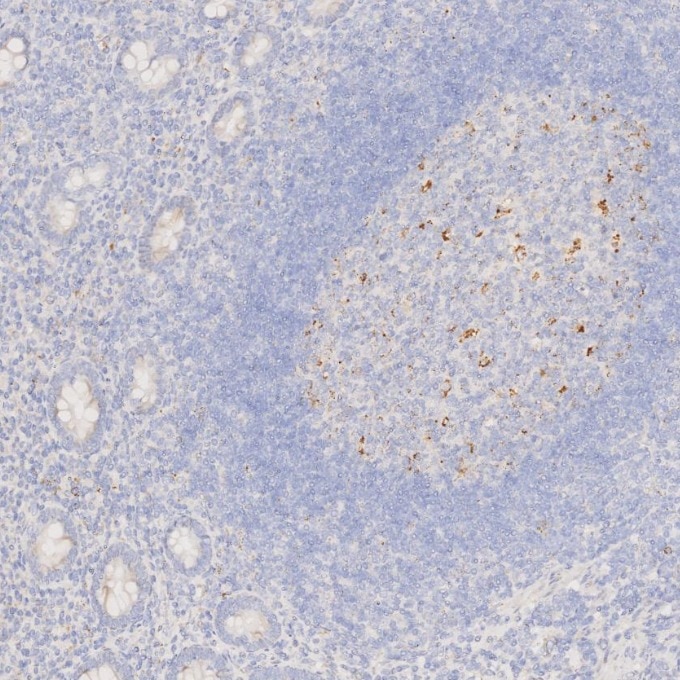 IHC staining of human appendicitis using 60259-2-Ig Immunohistochemistry (IHC) staining of human appendicitis tissue using Napsin A Monoclonal antibody (60259-2-Ig)