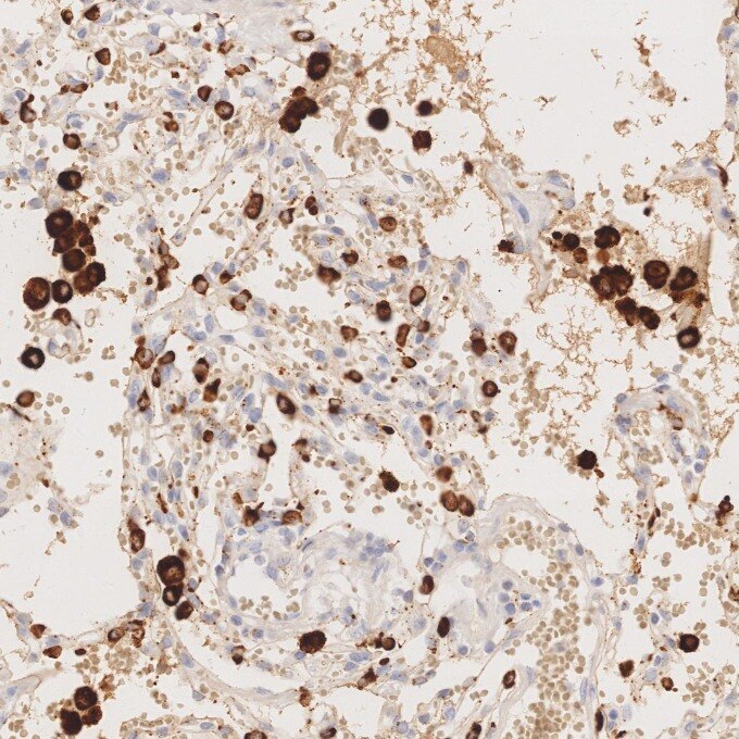 IHC staining of human lung using 60259-2-Ig Immunohistochemistry (IHC) staining of human lung tissue using Napsin A Monoclonal antibody (60259-2-Ig)