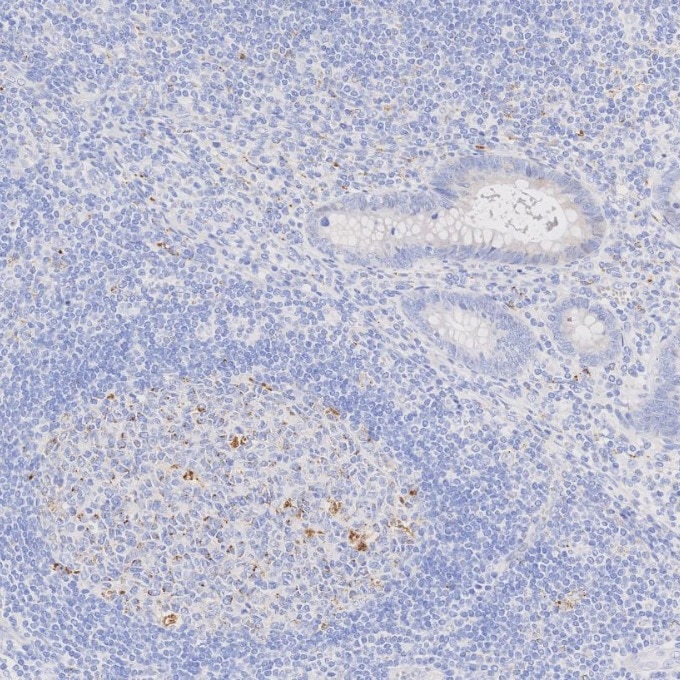 IHC staining of human appendicitis using 60259-2-Ig Immunohistochemistry (IHC) staining of human appendicitis tissue using Napsin A Monoclonal antibody (60259-2-Ig)