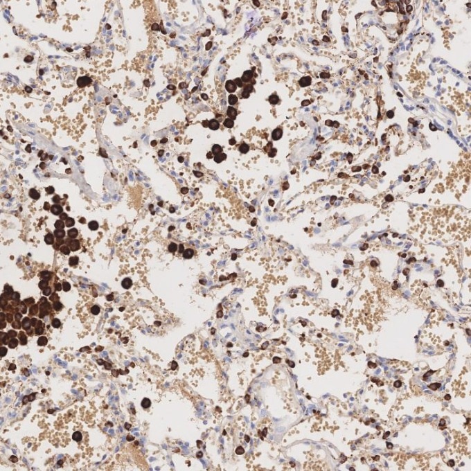 IHC staining of human lung using 60259-2-Ig Immunohistochemistry (IHC) staining of human lung tissue using Napsin A Monoclonal antibody (60259-2-Ig)