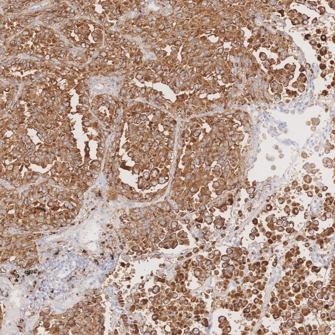IHC staining of human lung cancer using 60259-2-Ig Immunohistochemistry (IHC) staining of human lung cancer tissue using Napsin A Monoclonal antibody (60259-2-Ig)