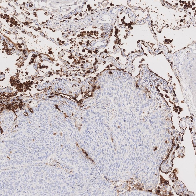 IHC staining of human lung cancer using 60259-2-Ig Immunohistochemistry (IHC) staining of human lung cancer tissue using Napsin A Monoclonal antibody (60259-2-Ig)