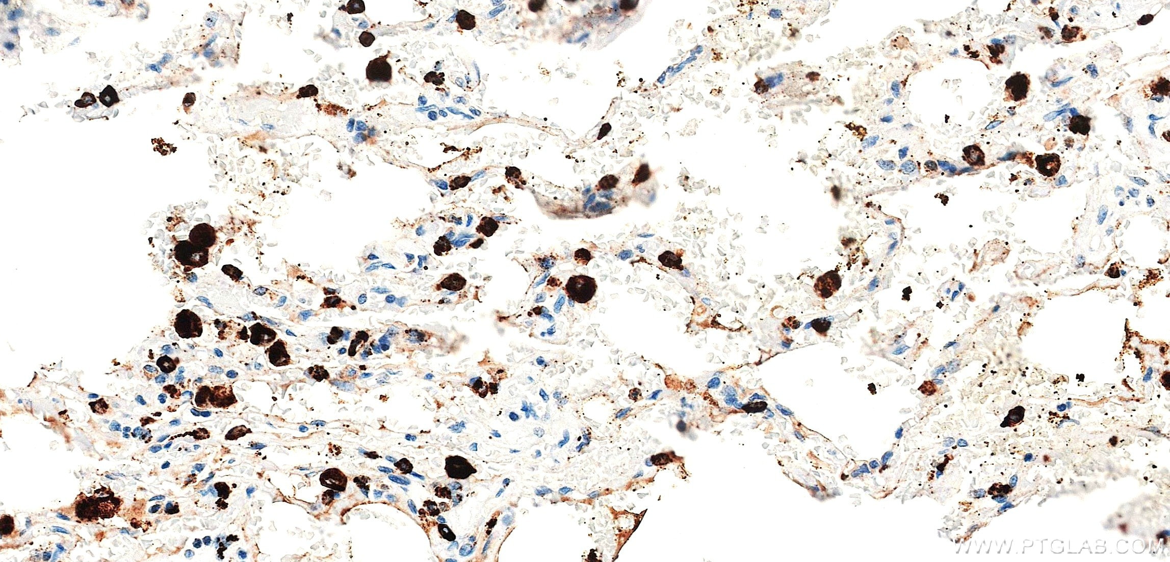 Immunohistochemistry (IHC) staining of human lung tissue using Napsin A Recombinant monoclonal antibody (86052-4-RR)