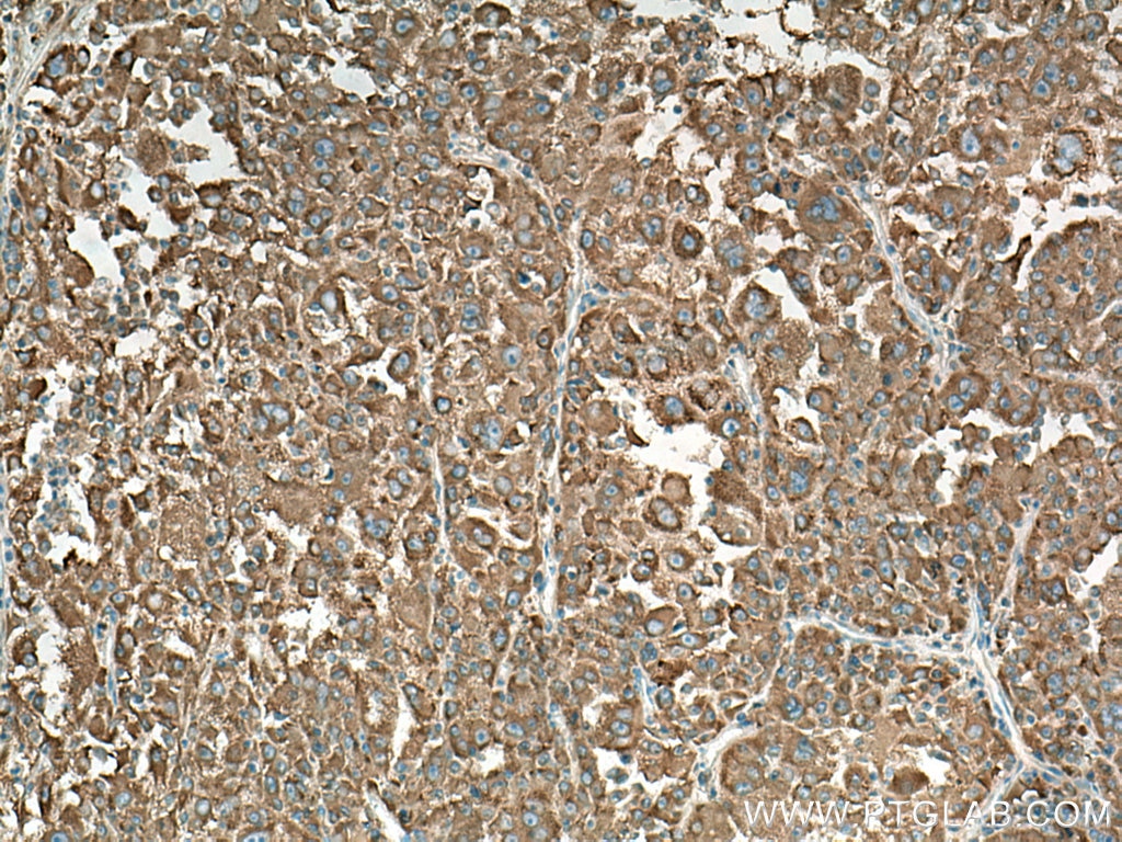 Immunohistochemistry (IHC) staining of human liver cancer tissue using NARS Polyclonal antibody (14882-1-AP)