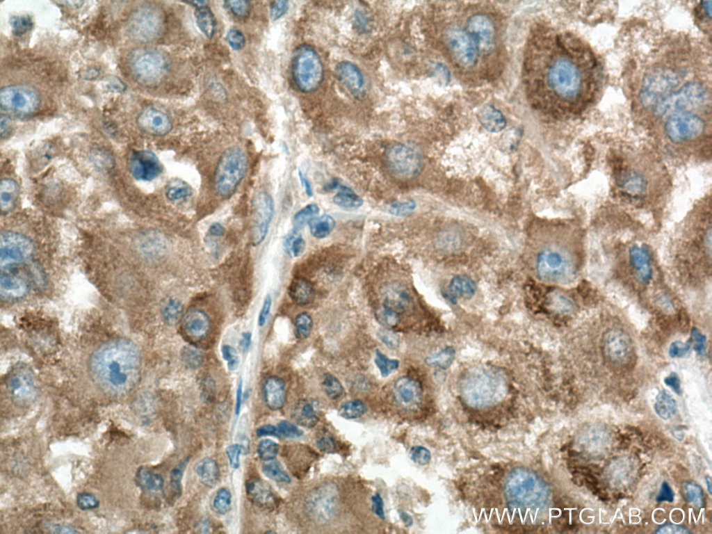 Immunohistochemistry (IHC) staining of human liver cancer tissue using NARS Polyclonal antibody (14882-1-AP)