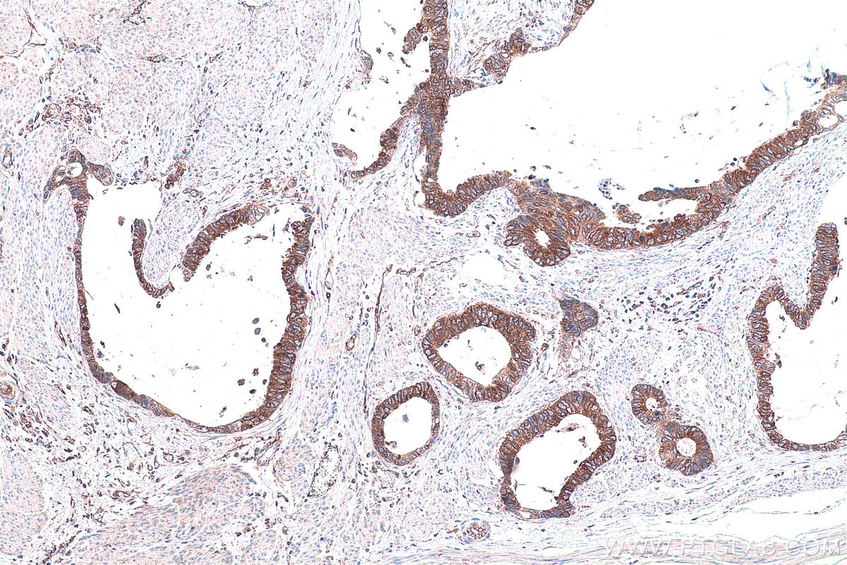 Immunohistochemistry (IHC) staining of human urothelial carcinoma tissue using NARS Monoclonal antibody (67711-1-Ig)