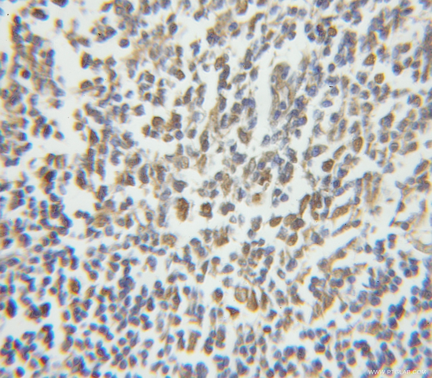 IHC staining of human lymphoma using 11323-1-AP
