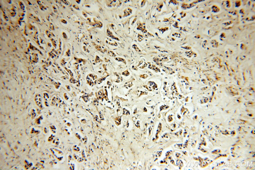 Immunohistochemistry (IHC) staining of human breast cancer tissue using NAT1 Polyclonal antibody (14394-1-AP)