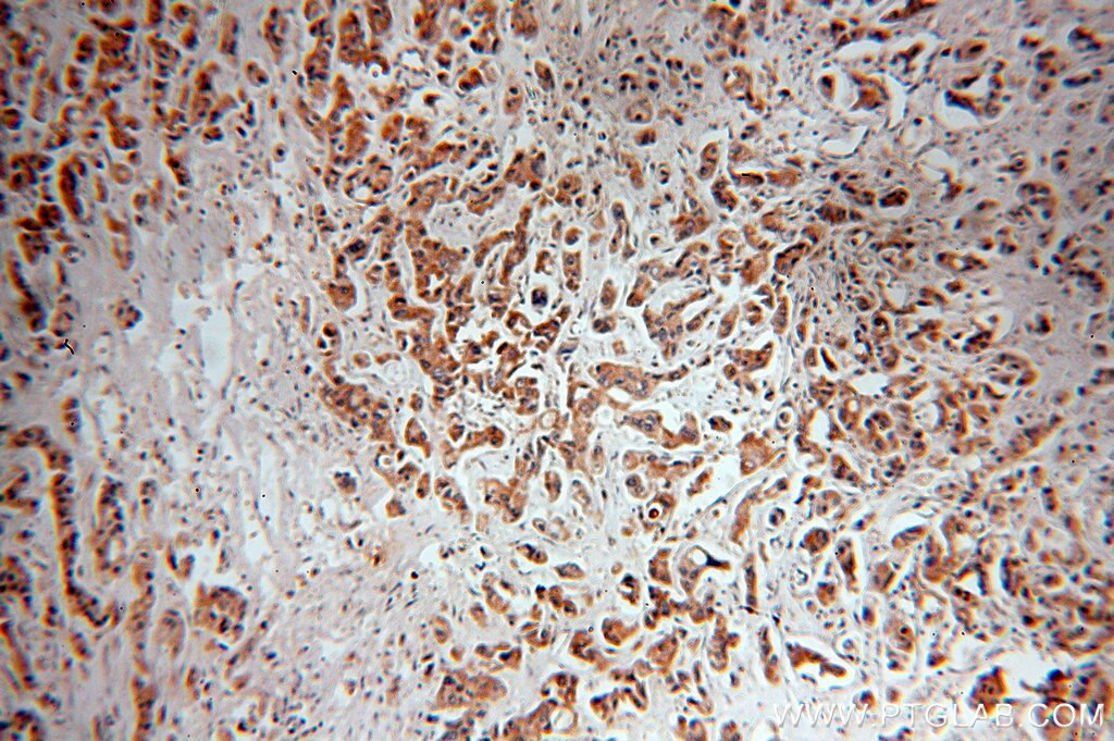 Immunohistochemistry (IHC) staining of human breast cancer tissue using NAT1 Polyclonal antibody (19188-1-AP)