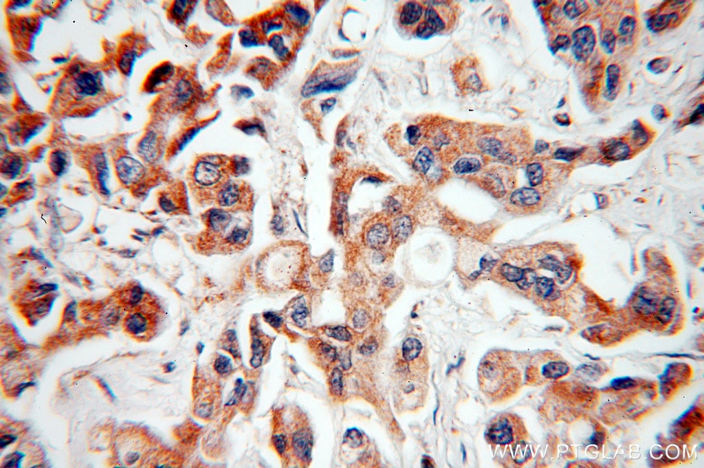Immunohistochemistry (IHC) staining of human breast cancer tissue using NAT1 Polyclonal antibody (19188-1-AP)