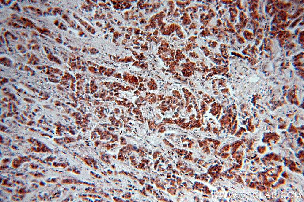 Immunohistochemistry (IHC) staining of human breast cancer tissue using NAT1 Polyclonal antibody (19188-1-AP)