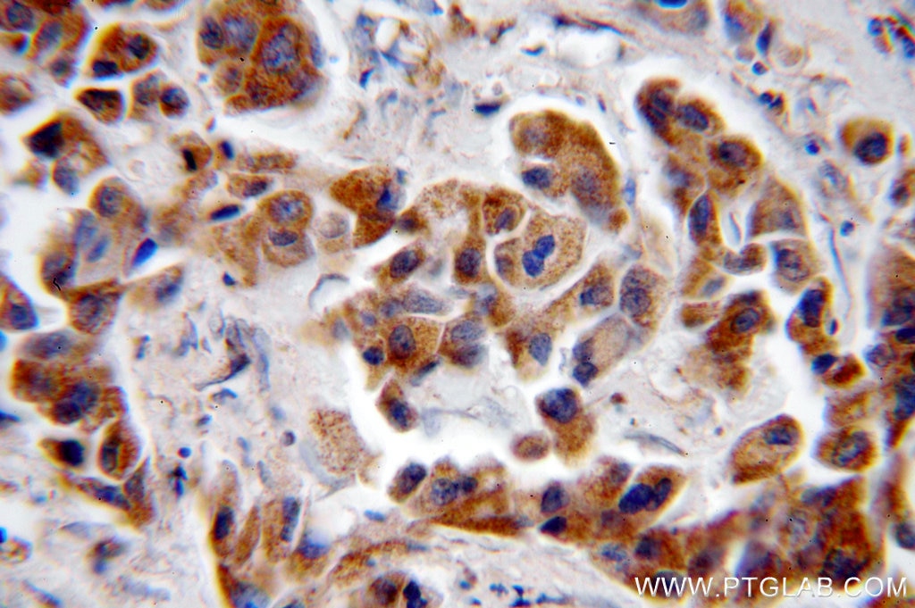 Immunohistochemistry (IHC) staining of human breast cancer tissue using NAT1 Polyclonal antibody (19188-1-AP)