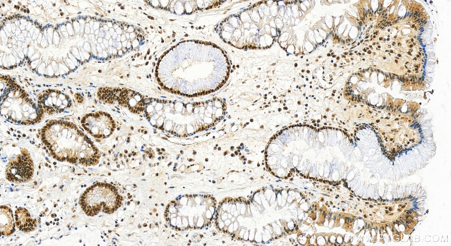 Immunohistochemistry (IHC) staining of human stomach cancer tissue using NAT10 Polyclonal antibody (13365-1-AP)