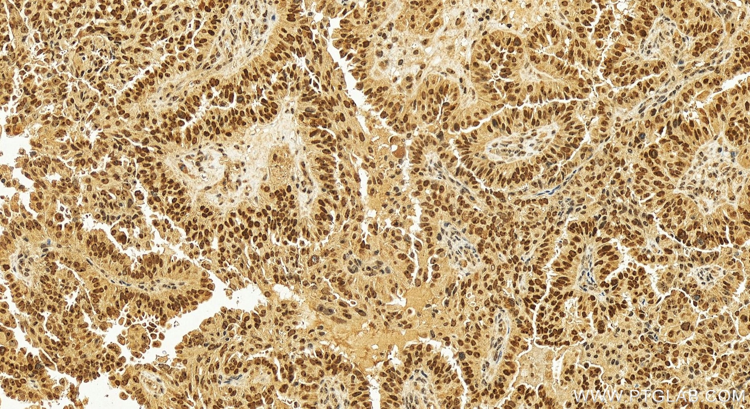 Immunohistochemistry (IHC) staining of human ovary cancer tissue using NAT10 Polyclonal antibody (13365-1-AP)
