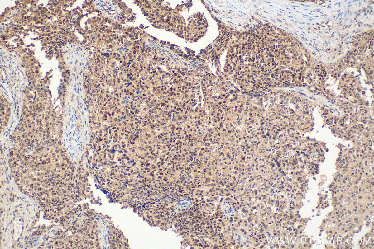 Immunohistochemistry (IHC) staining of human ovary cancer tissue using NAT10 Polyclonal antibody (13365-1-AP)