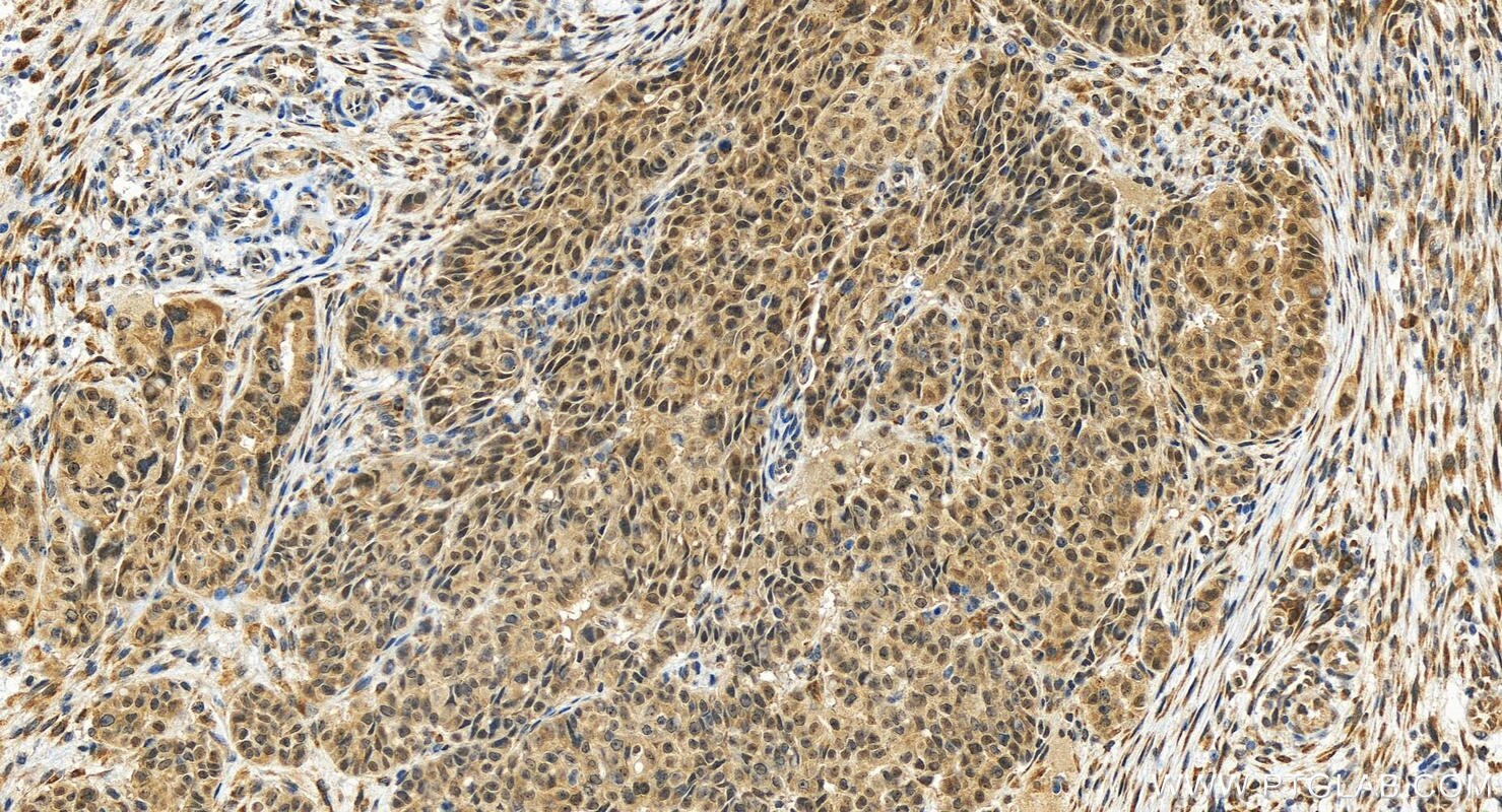 Immunohistochemistry (IHC) staining of human ovarian  cancer using NAA40 Polyclonal antibody (16698-1-AP)