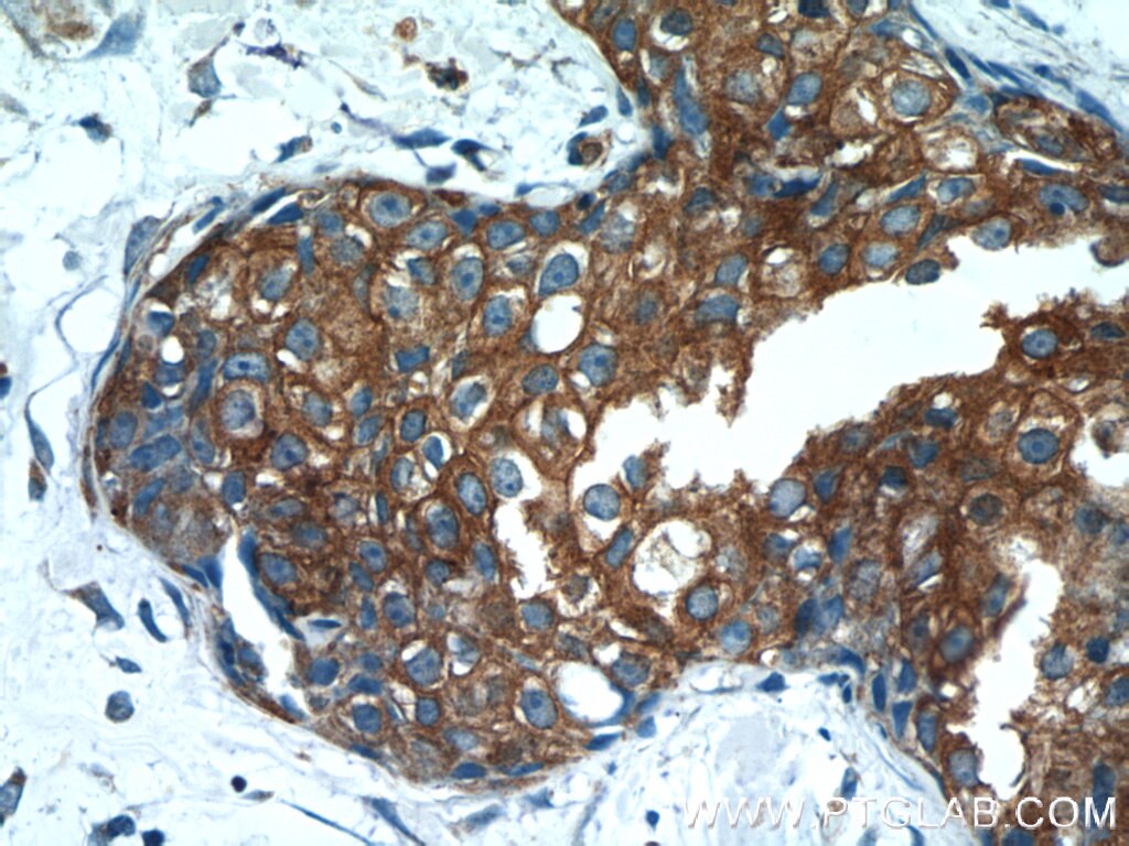 Immunohistochemistry (IHC) staining of human breast cancer tissue using NAT2 Polyclonal antibody (11410-1-AP)