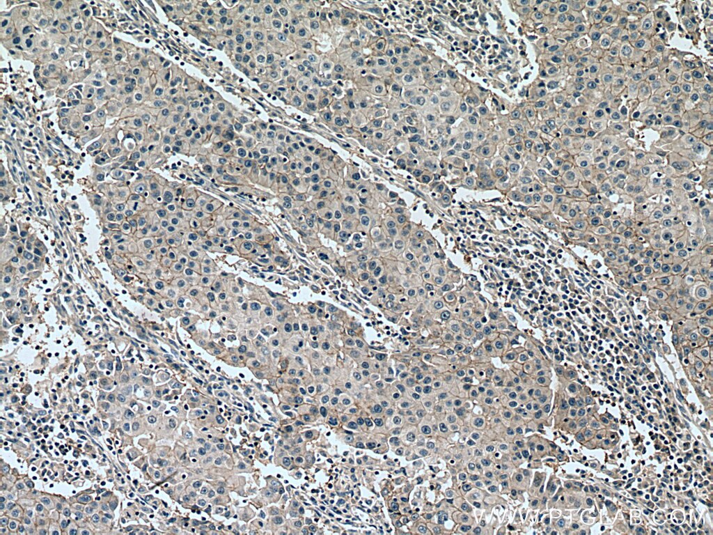 Immunohistochemistry (IHC) staining of human breast cancer tissue using NAT2 Polyclonal antibody (11410-1-AP)