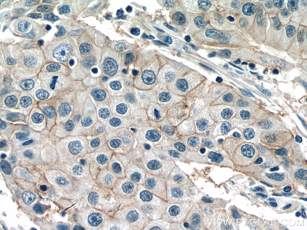 Immunohistochemistry (IHC) staining of human breast cancer tissue using NAT2 Polyclonal antibody (11410-1-AP)